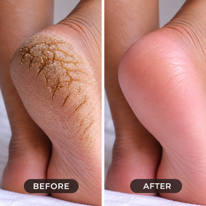 Electric Foot File & Callus Remover